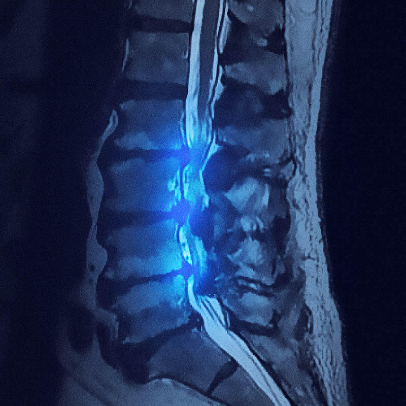 Spinal Stenosis - Biscup Spine